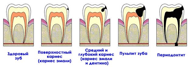 Кариес зубов