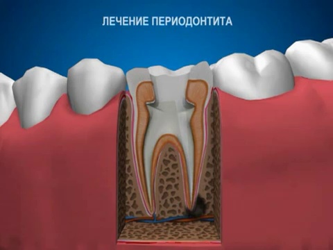 периодонтит зуба фото